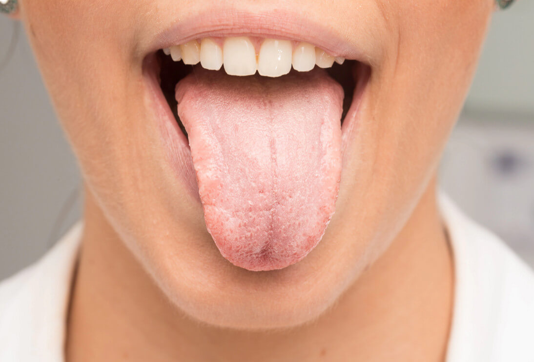 Как убрать налет с языка